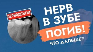 Когда перед стоматологом стоит снять шляпу? Периодонтит!