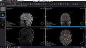 МРТ построение головного Мозга