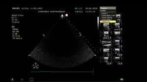 УЗИ СОСУДОВ ГОЛОВЫ И ШЕИ НОРМА