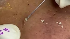 Relax squeezing out blackheads #47 Черные точки