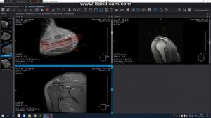 МРТ построение плечевого сустава