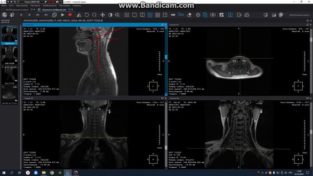 МРТ построение мягких тканей шеи смотреть онлайн