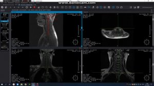 МРТ построение мягких тканей шеи