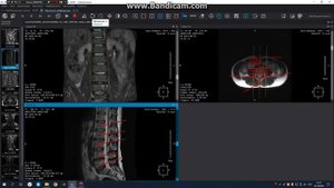 МРТ построение поясничного отдела