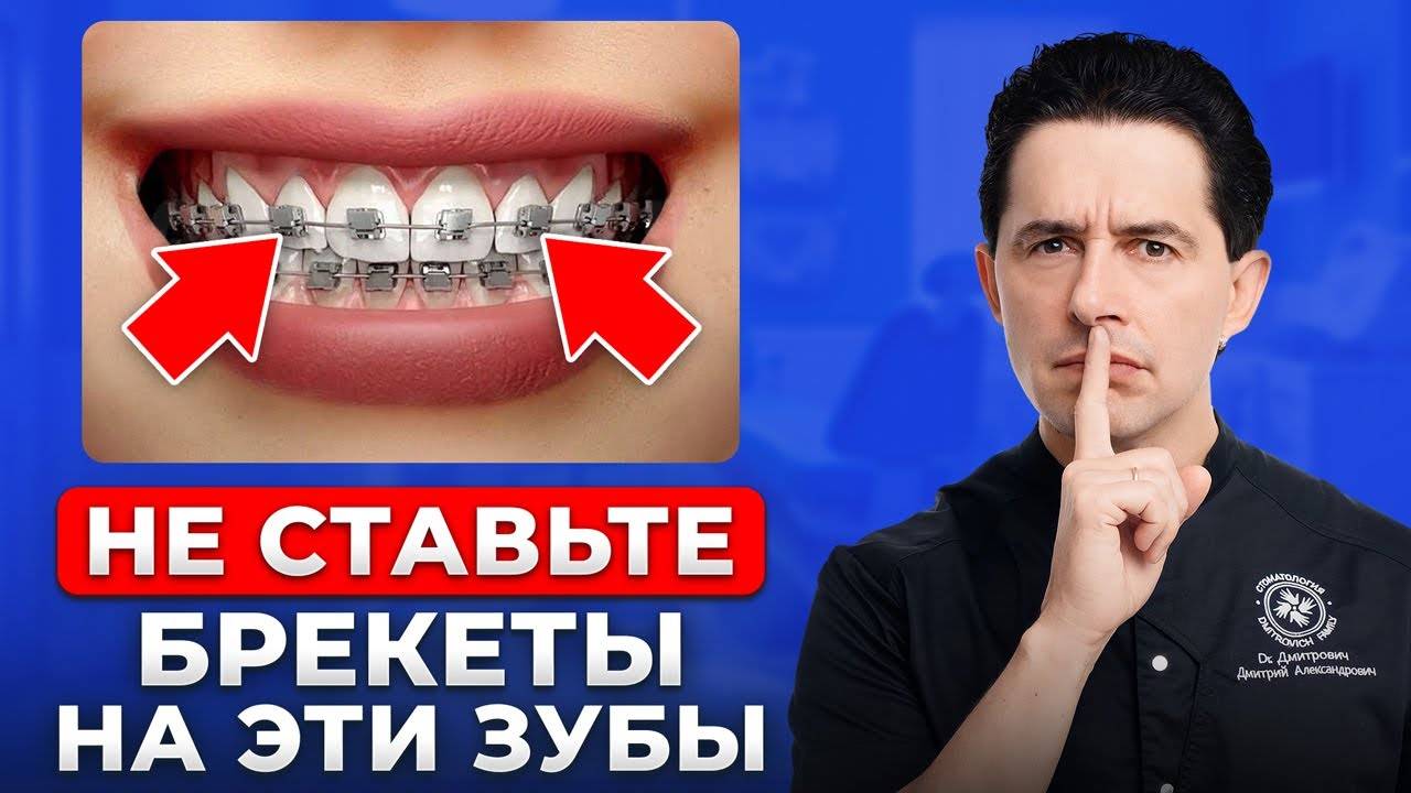 Главная ошибка при установке брекетов. Как сохранить деньги?