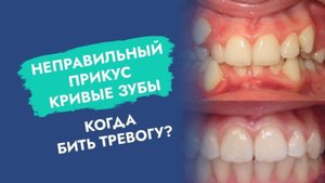 Самые серьезные проблемы с прикусом у детей и подростков!