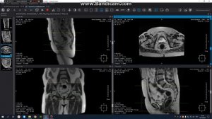 МРТ построение мужской м/Таз без простаты