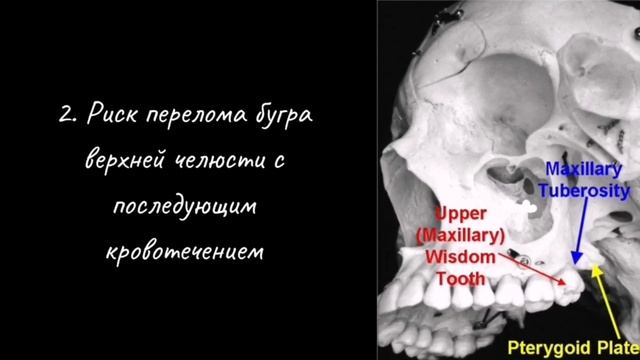 #зубмудрости #третиймоляр #члх #хирургическаястоматология #удалениезубовмудрости #зуб