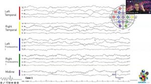 Multicenter ICU EEG Collaboration: Opportunities & Pitfalls