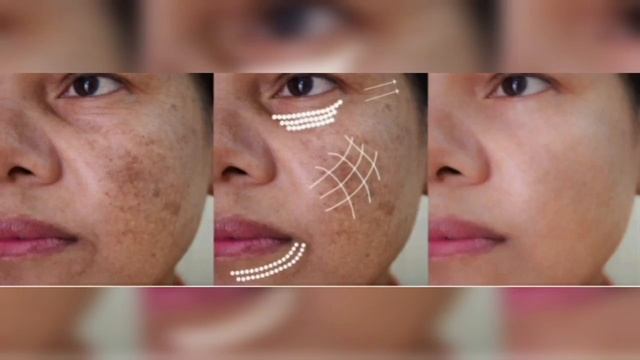 How to Remove Pigmentation/Freckles/Melasma || Oriflame Evenout Creams #Oriflame #how