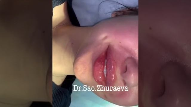 Аугментация губ филером гиалуроновой кислоты 😍😍😍