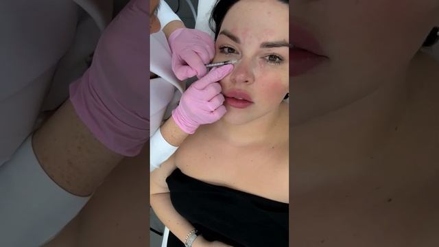 БОТОКС FULL FACE для себя 💉 #косметолог #омоложениелица #клиникакосметологии #ботокс #fullface