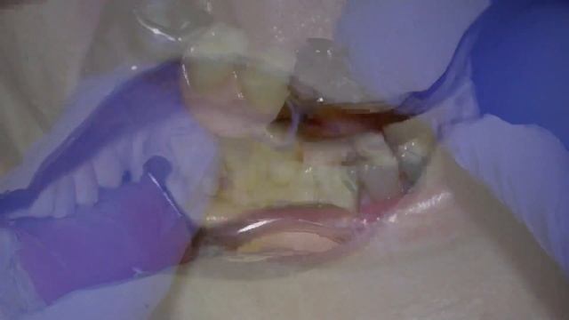 Fitting a Metal Based Chrome Cobalt Partial Denture смотреть онлайн