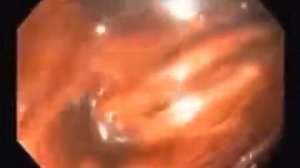 Чистота кишечника залог вашего крепкого здоровья ❗️Паразиты в кишечнике.