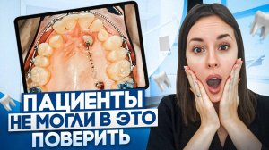 Кривые Зубы: Результаты ДО и ПОСЛЕ! Лечение на брекетах и элайнерах!