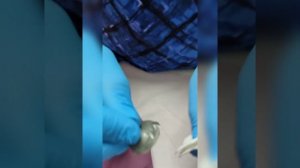 Процедура лазера с установкой шильды