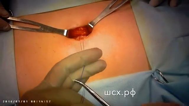 пупочная грыжа, пластика местными тканями