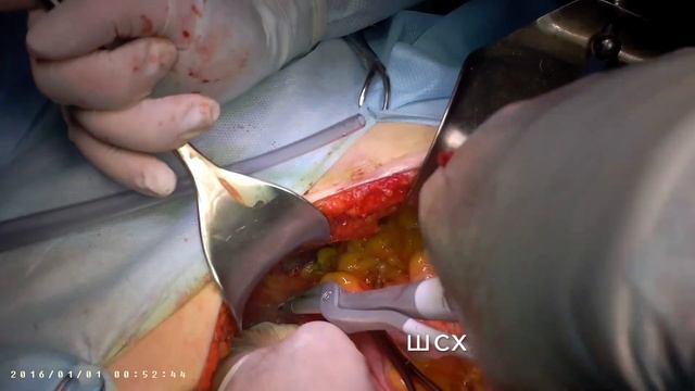 Proximal gastrectomy with double-truck reconstruction. Проксимальная резекция желудка