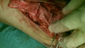 Patellar tendon shortening surgery