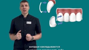 Про виниры 1