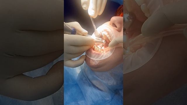 Удаление зуба с одномоментной имплантацией #имплантация#стоматология#ridere#удалениезуба#dentist