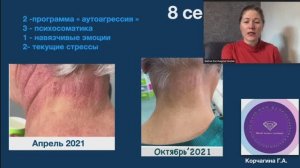 8 сессий к чистой коже, работа с нейродермитом , Конгресс по психотерапии, Москва, 2021