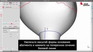 Полная анатомия на винтовой фиксации из премилла (Pre-milled Occ Integreted Crown)