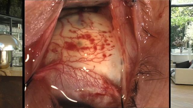 Retinal Detachment - 8: Indentation