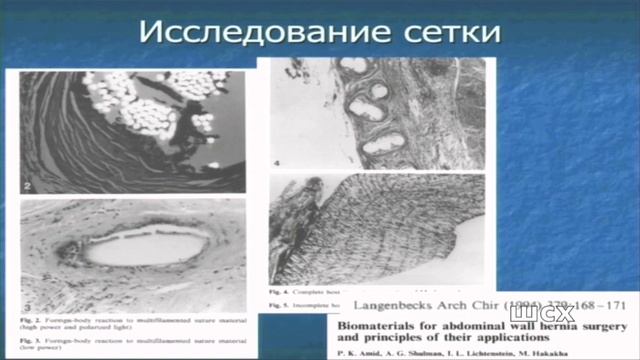 Пластика Лихтенштейна (лекция)