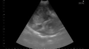 гемангиосаркома сердце