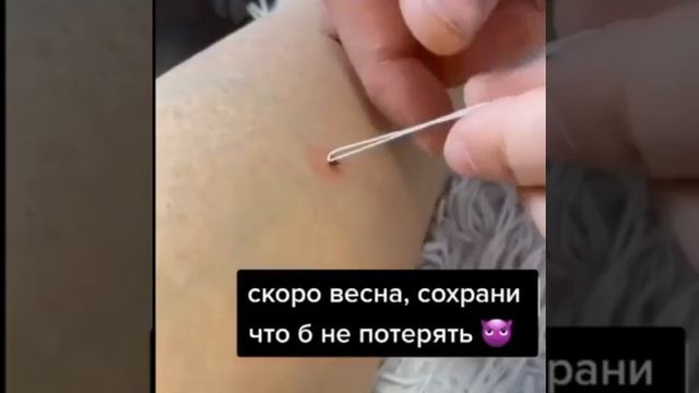 🕷 Как удалить клеща, запоминаем!