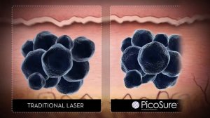 PicoSure Laser tattoo removal available at Esteem Medi Spa