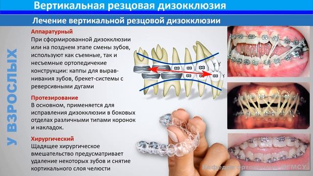 5_3_Аномалии_окклюзии_по_вертикали смотреть онлайн