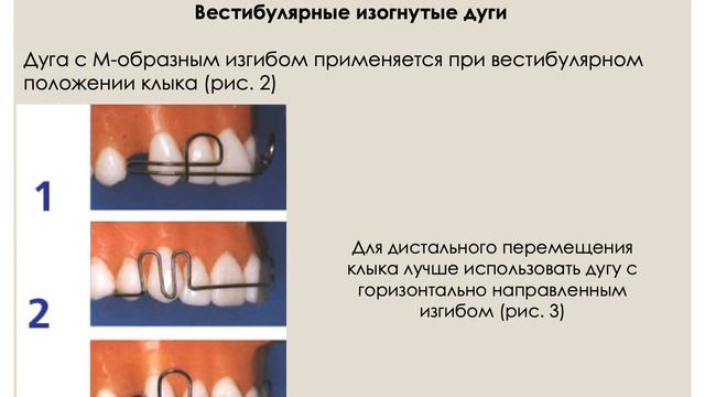 5_8г_Ортодонтическое_лечение_аппаратами_механического_действия