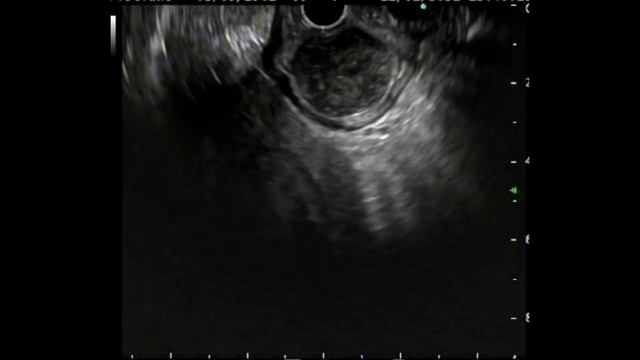 Gastrointestinal stromal tumor (GIST)  stomach in Gastroscopy and Endosonography