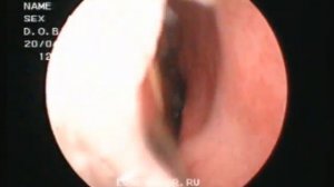 лазерная деструкция нижних носовых раковин