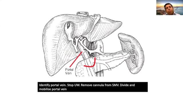 LGS - Liver Transplantation; Ltx Organ Retrieval Dr.Ashwin Rammohan смотреть онлайн