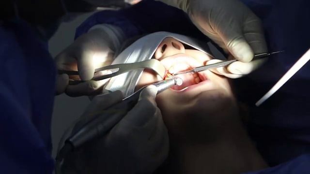 დენტალური იმპლანტაცია Dental implant placement смотреть онлайн