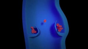 Как вылечить варикоз_