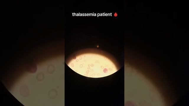 thalassemia patient | thalassemia slide | microscopy #laboratory