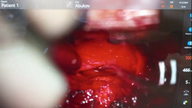 Поездка в ПСПбГМУ им. Павлова 2024. Спинальная эндоскопия. UBESS смотреть онлайн