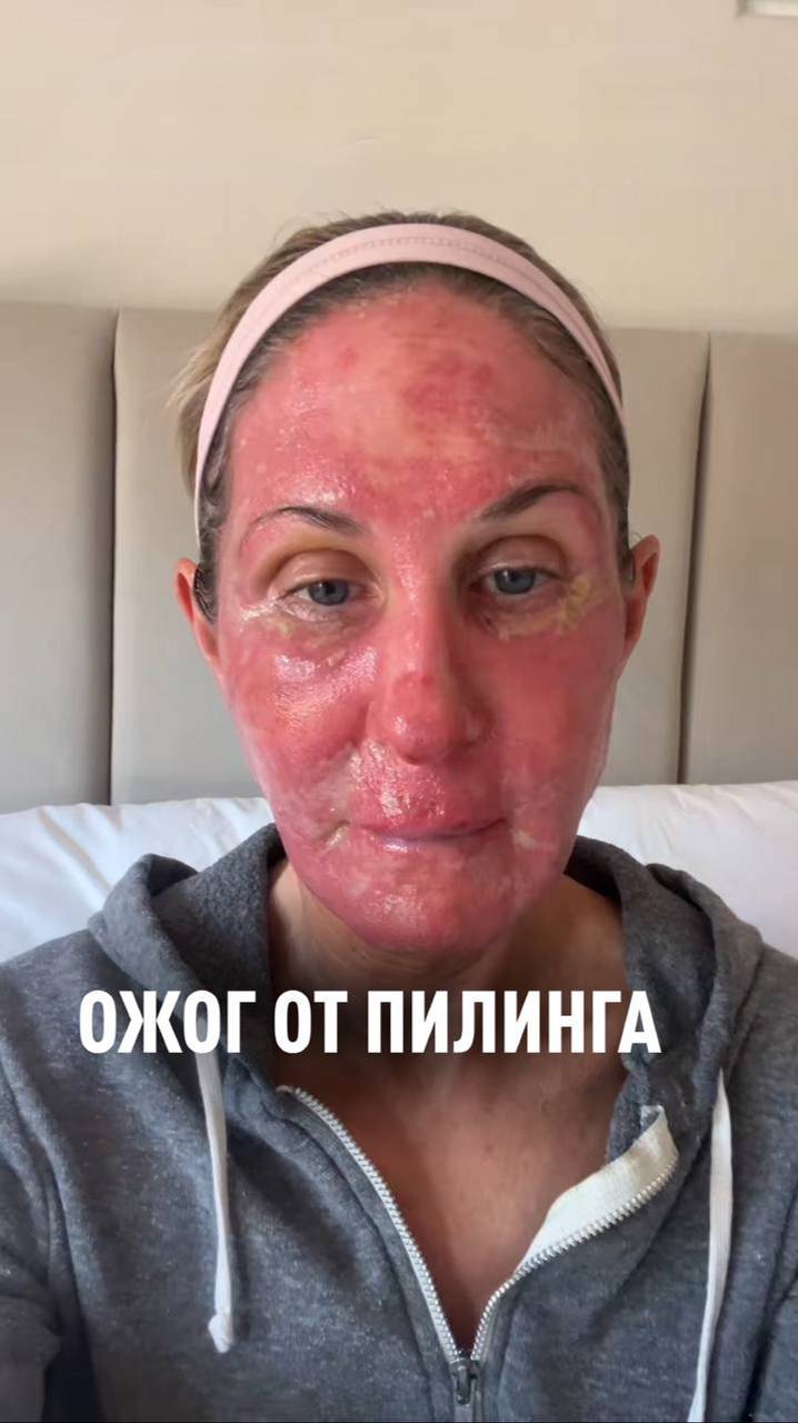 ОЖОГ ЛИЦА ОТ ПИЛИНГА смотреть онлайн