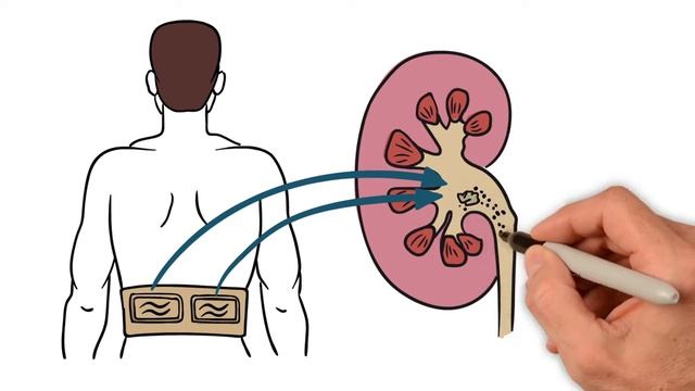 Удаление камней из почек без дробления и операции смотреть онлайн