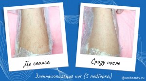 Электроэпиляция голени методом blend