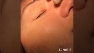 Уудаление милиума лазером. Пластический хирург Листратенков