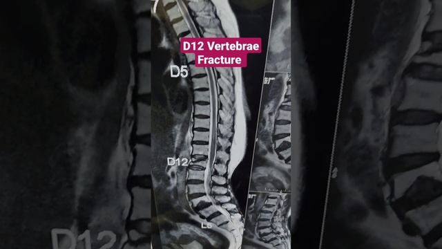 D12 Vertebrae Fracture ...Dr Sai Chandra MBBS DNB Ortho