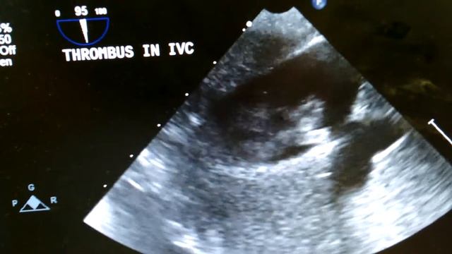 "Кролик" в НПВ. Прорастание карциномы. смотреть онлайн