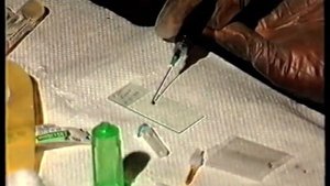 филяриозы лимфатической системы (filariasis of the lymphatic system)