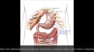 Шунтирование желудка для снижения веса _ Оспанов 1
