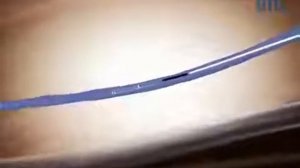 Лечим  варикоз лазером